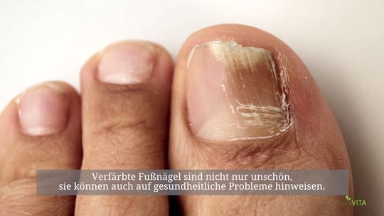 gelbe fussnagel ursachen und behandlung